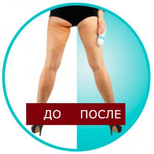 Эффективен ли лучший антицеллюлитный крем