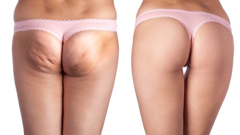 Эффективно ли лазерное лечение целлюлита