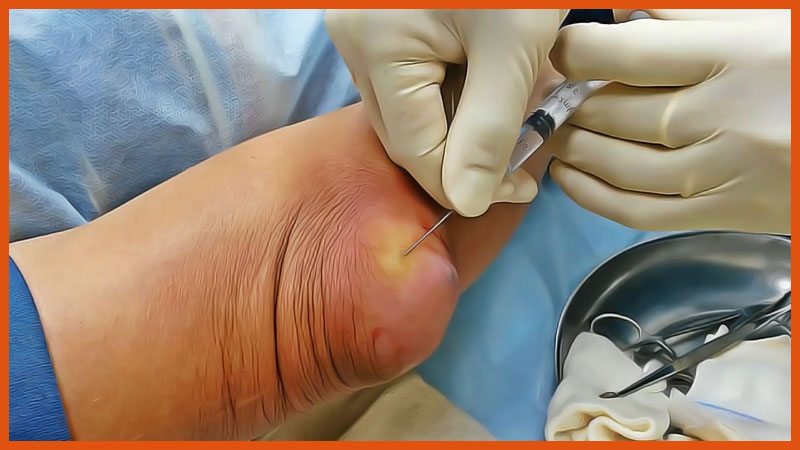 Как лечить бурсит голеностопного сустава