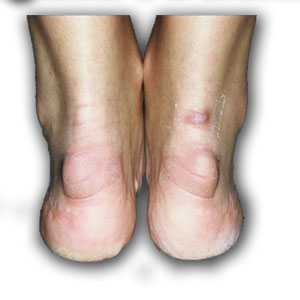 Как лечить деформацию Хаглунда (апофизит)