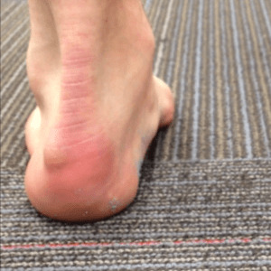 Как лечить деформацию Хаглунда (апофизит)