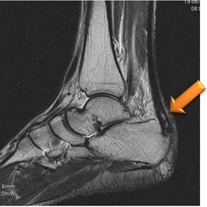Как лечить деформацию Хаглунда (апофизит)