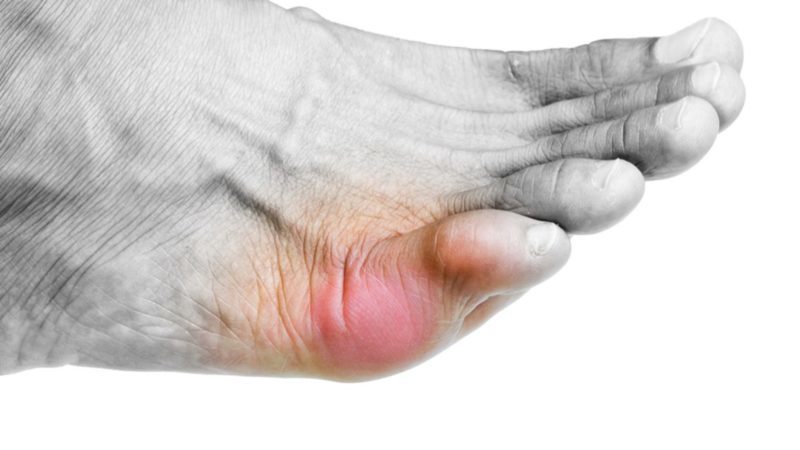 Как лечить деформацию Тейлора