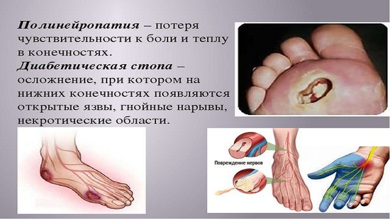 Как лечить диабетическую стопу