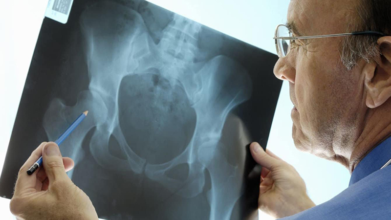 Как лечить кисту тазобедренного сустава