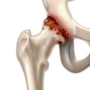 Как лечить коксит тазобедренного сустава