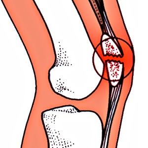 Как лечить перелом мыщелка коленного сустава
