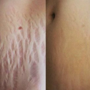 Как отзываются о креме, спрее и масле Саносан от растяжек