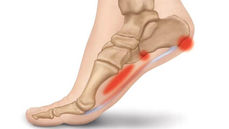 Как правильно носить ортез на голеностопном суставе