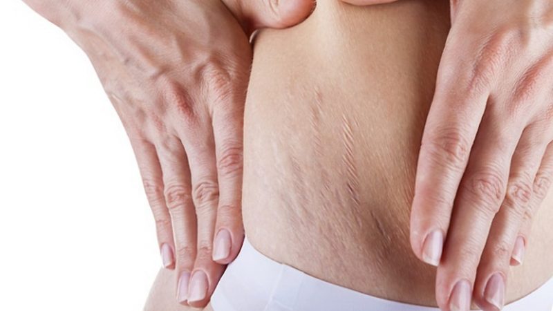 Как применяется оливковое масло от растяжек