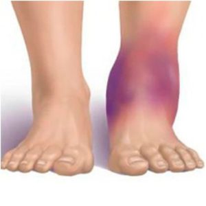 Лечение переломов кубовидной и ладьевидной костей