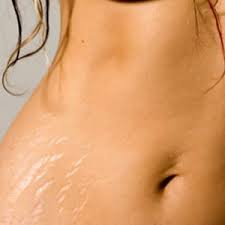 Насколько эффективен химический пилинг от растяжек