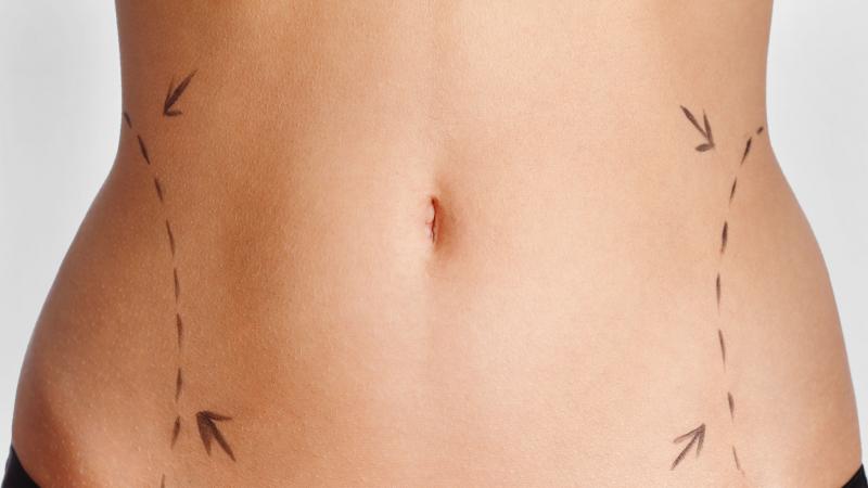 Осложнения при восстановлении после липосакции