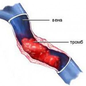 почему отекает нога