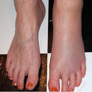 отек на ноге