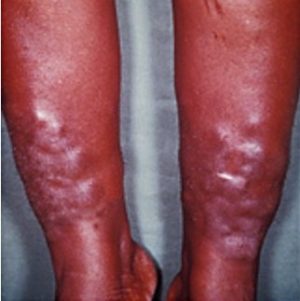 с чем связаны отеки ног