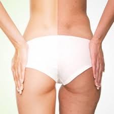 Почему целлюлита стало больше после массажа