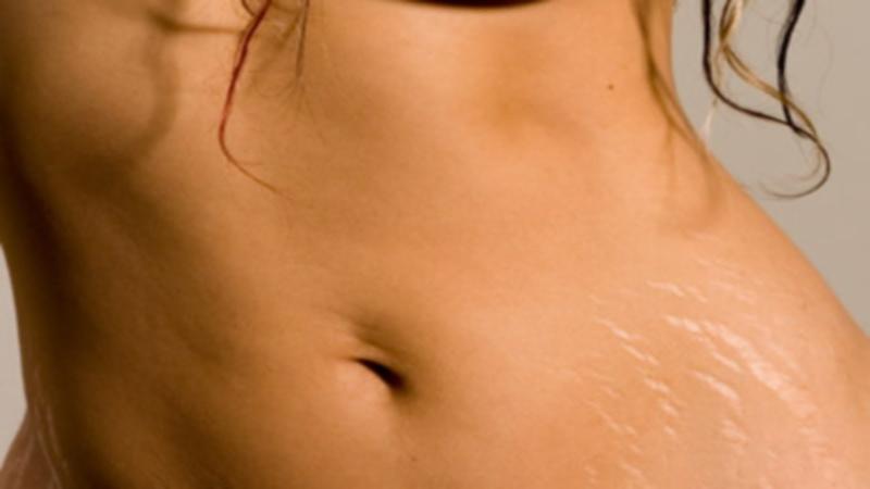 Помогает ли крем Elancyl от растяжек и целлюлита