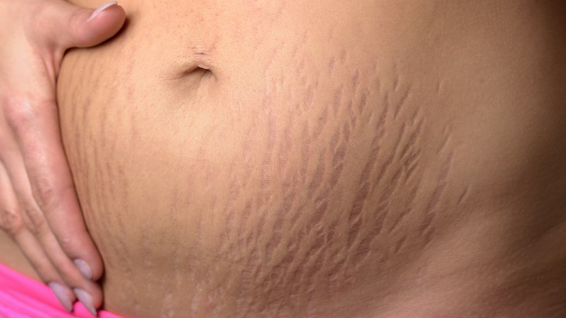 Помогает ли крем Клирвин от растяжек на теле