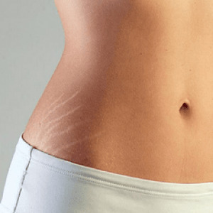 Помогает ли крем Виши (Vichy)от растяжек