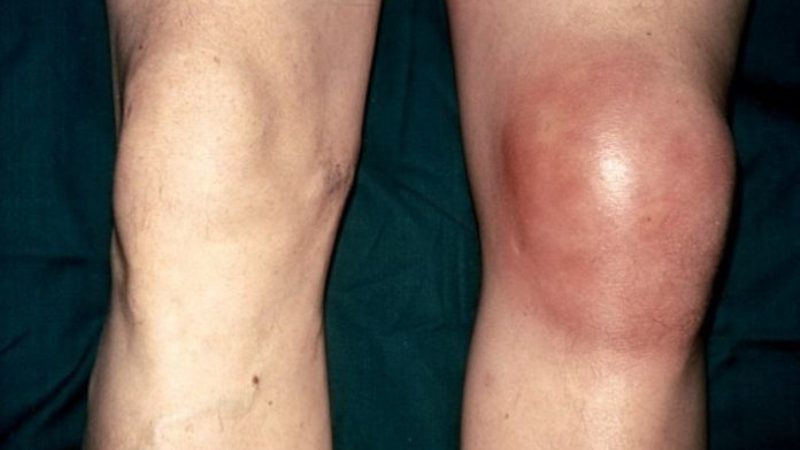 Строение надколенника и как лечить разрыв его связки