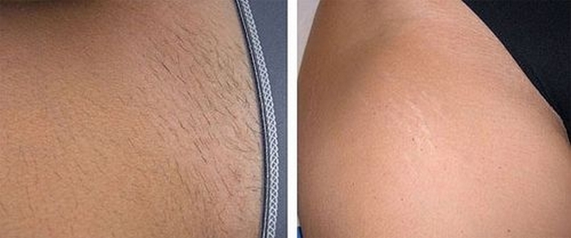 Что такое AFT эпиляция