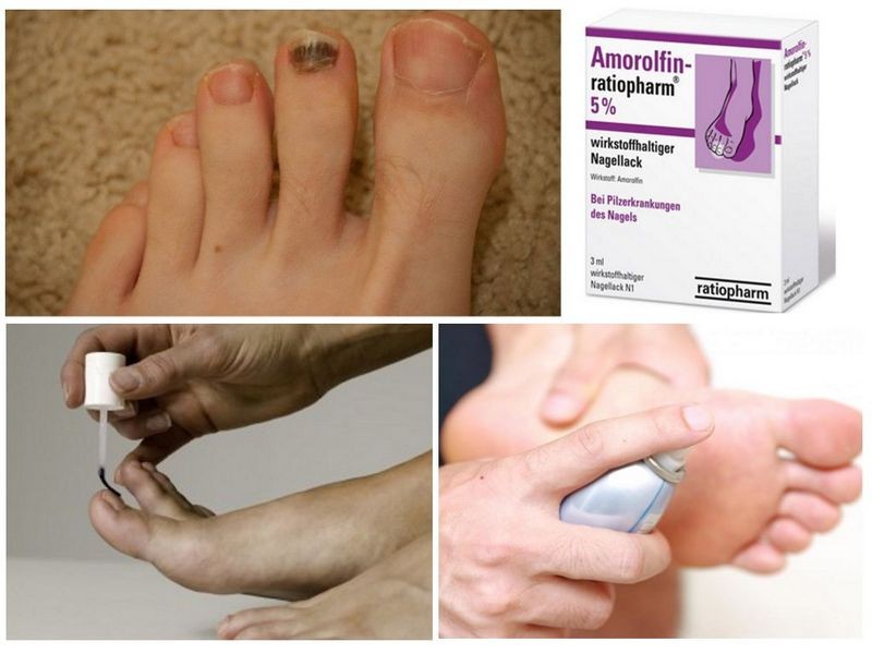 Препарат Аморолфин от грибка ногтей: инструкция по применению