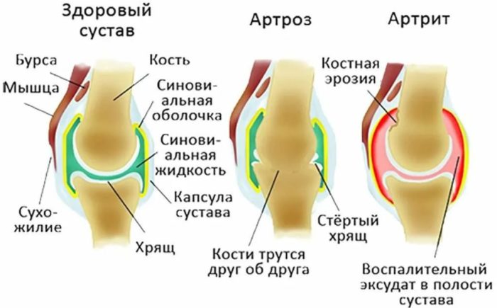 Какие есть анализы на заболевания суставов