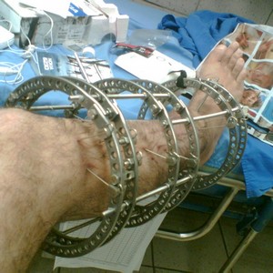 Что такое аппарат Илизарова