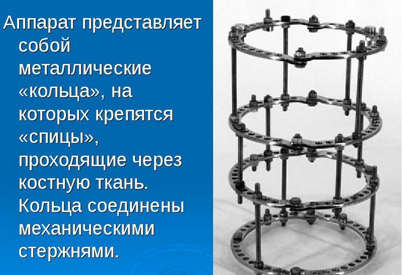 Что такое аппарат Илизарова