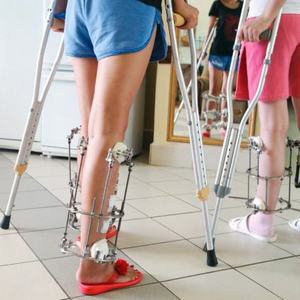 Что такое аппарат Илизарова