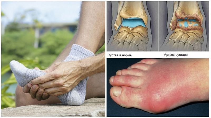 Как лечить артроз голеностопного сустава