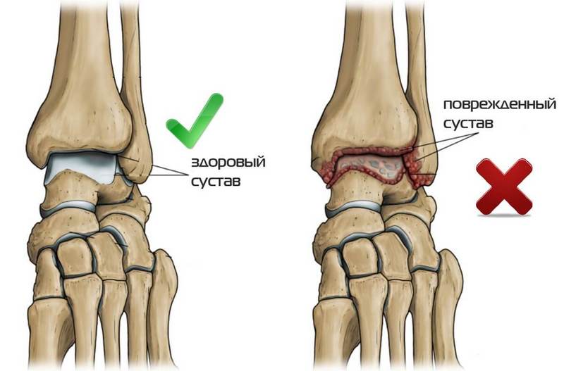 Как лечить посттравматический артроз