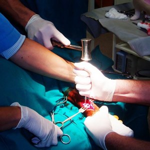 Как лечить посттравматический артроз