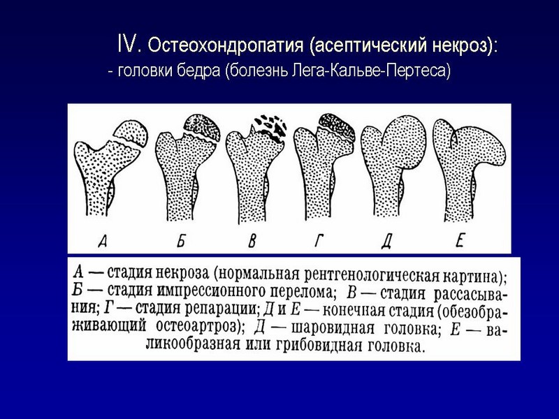 Как лечат асептический некроз головки тазобедренного сустава