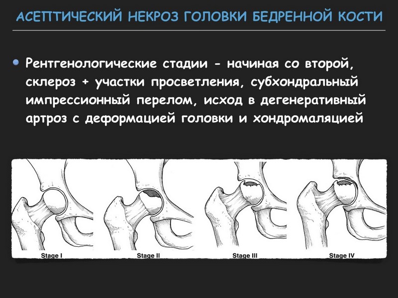 Как лечат асептический некроз головки тазобедренного сустава