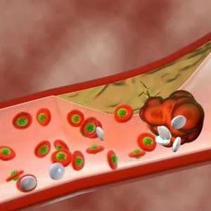 Как принимать аспирин при варикозном расширении вен нижних конечностей