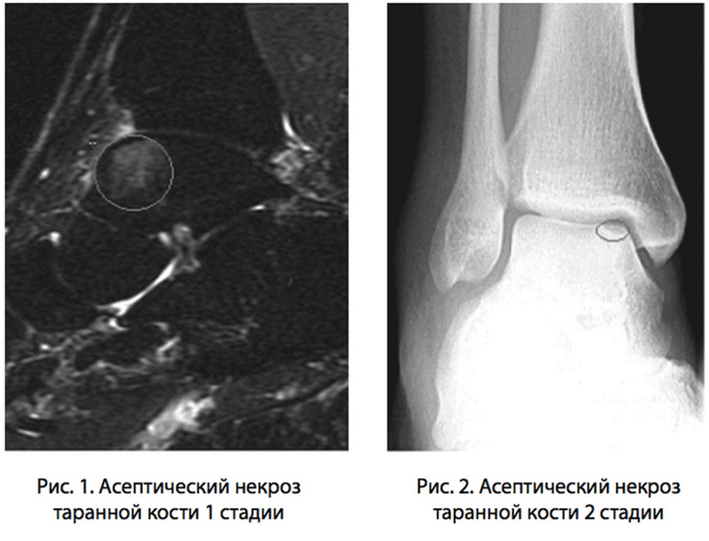 Асептический (аваскулярный) некроз таранной кости