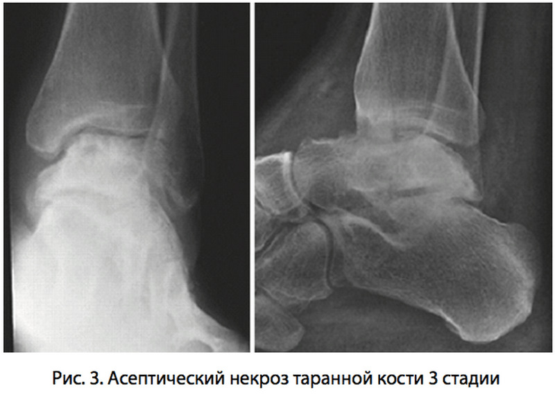 Асептический (аваскулярный) некроз таранной кости