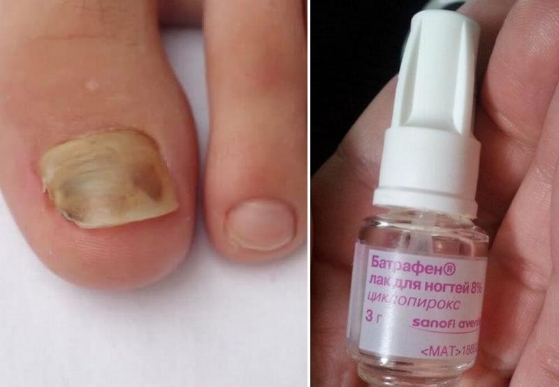 Лак Батрафен от грибка ногтей: инструкция по применению