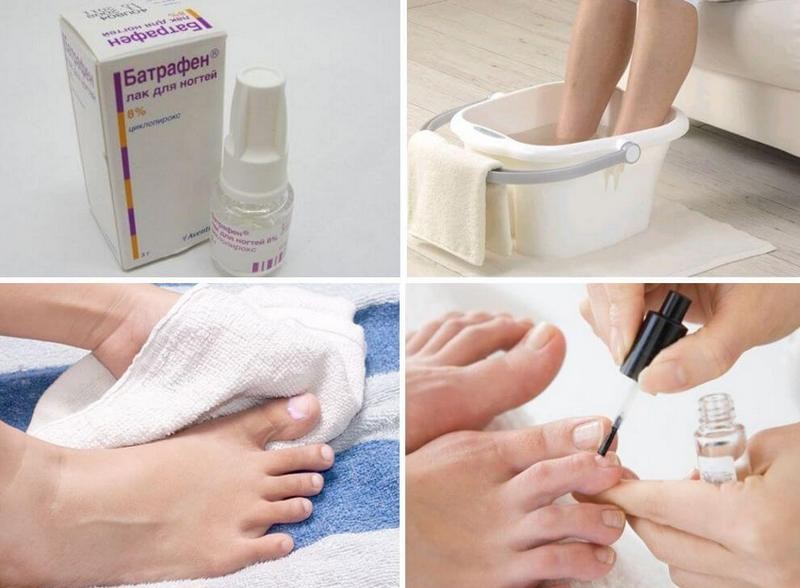 Лак Батрафен от грибка ногтей: инструкция по применению