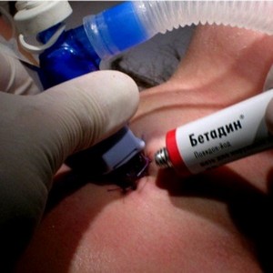 Лечение грибка ногтей препаратом Бетадин