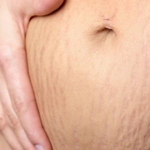 Эффективно ли масло Био Ойл от растяжек