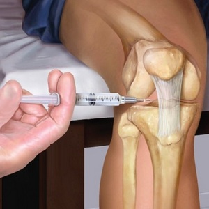 Что такое блокада коленного сустава