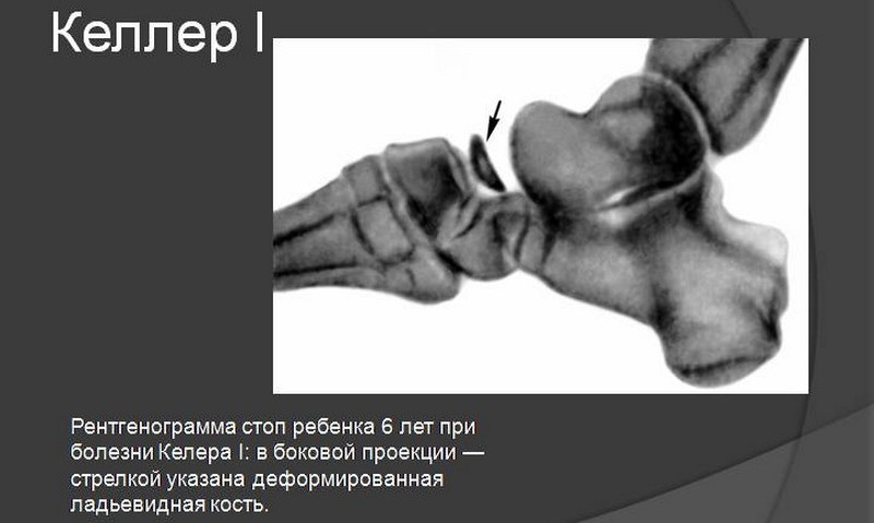 Что такое болезнь Келлера и как её лечить