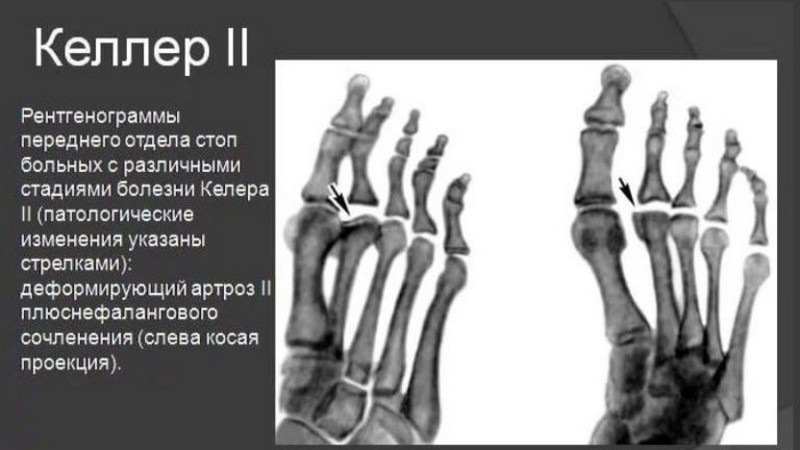 Что такое болезнь Келлера и как её лечить