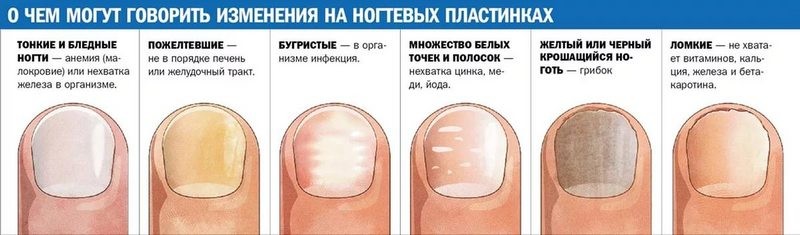 Какие существуют заболевания ногтей на ногах
