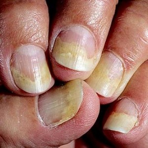 Какие существуют заболевания ногтей на ногах