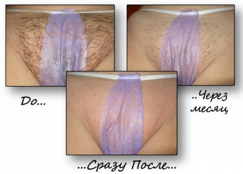 Как делается бразильская эпиляция зоны бикини