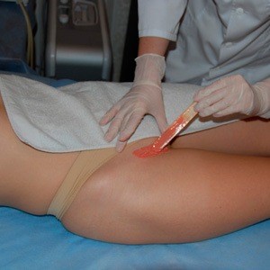 Как делается бразильская эпиляция зоны бикини